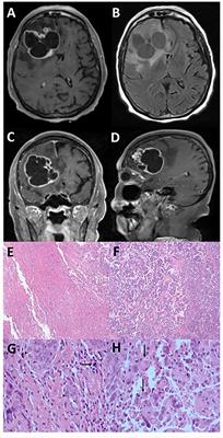 Dimorphic glioblastoma with glial and epithelioid phenotypes: Clonal evolution and immune selection